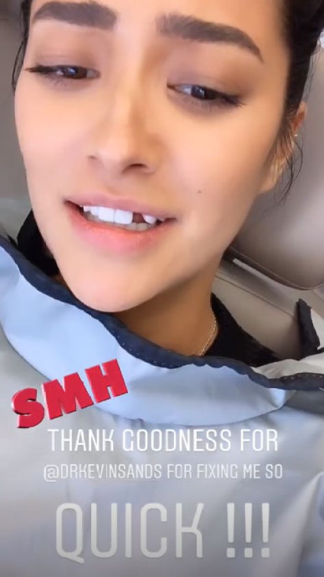 Shay Mitchell Looses Tooth