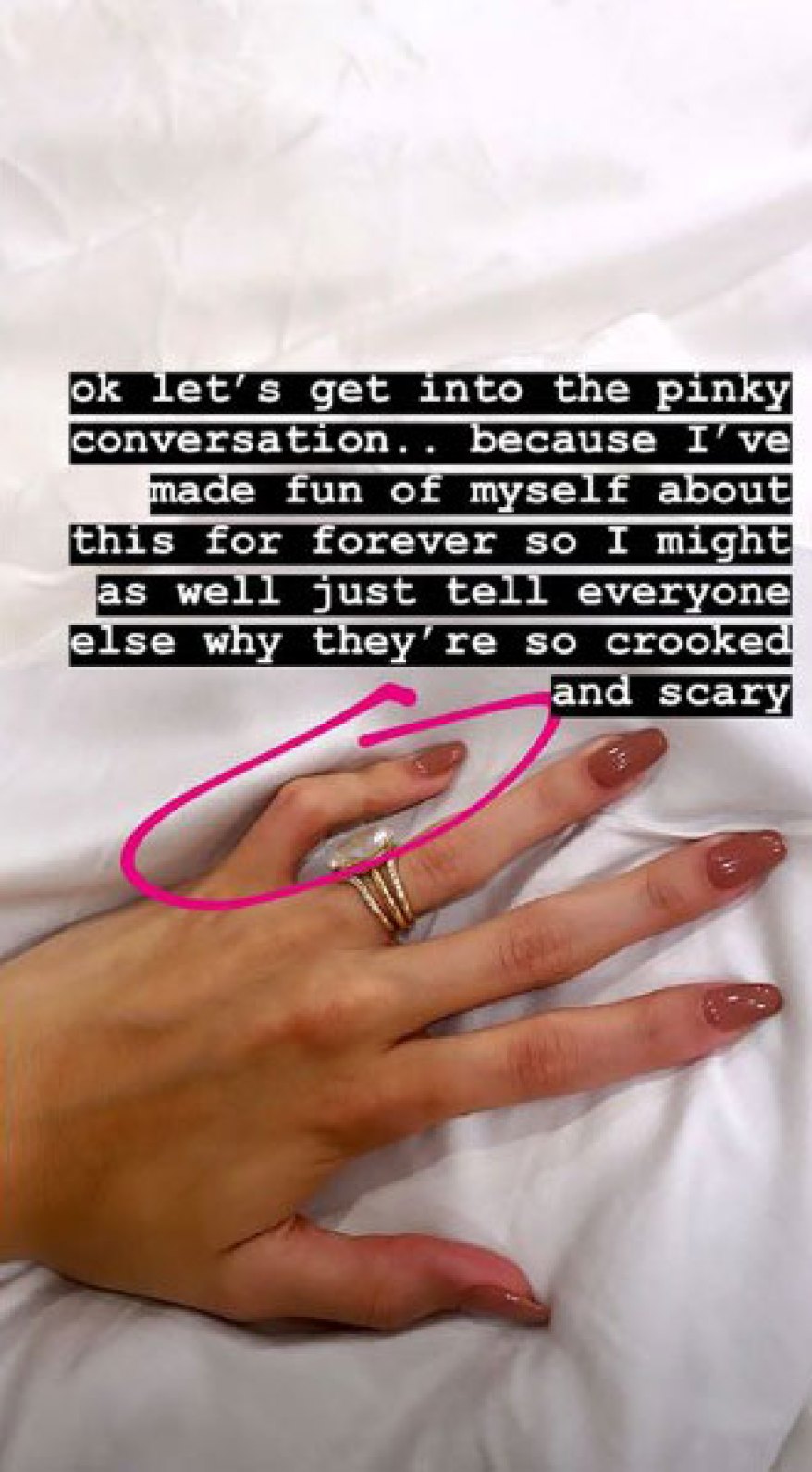 Hailey Baldwin Condition Crooked Pinky Finger