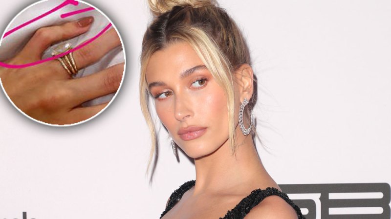 Hailey Baldwin Condition Crooked Pinky Finger