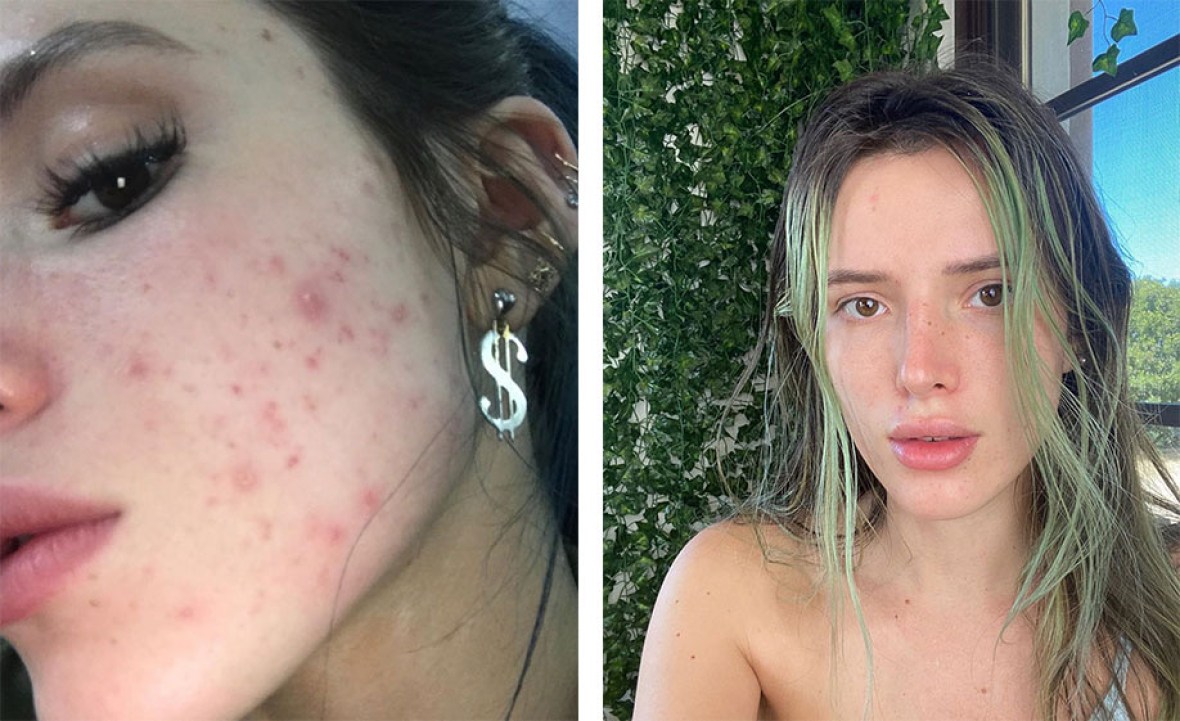 Bella Thorne Shares Amazing Before And After Photos Of Her Acne — Check Out Her Transformation
